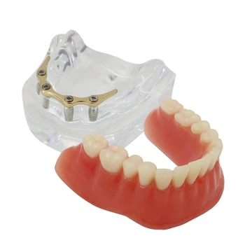 Стоматологическая модель зубов Precision 4 Implant Overdenture Нижний Зуб Золотистого цвета
